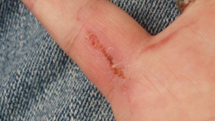 Znanstvenici pomoću struje ubrzali zarastanje rana: To će pomoći starijima i dijabetičarima