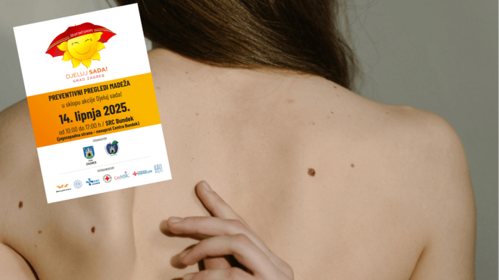 Besplatni pregled madeža u Zagrebu: Nije potrebna uputnica, a evo kada će se održati